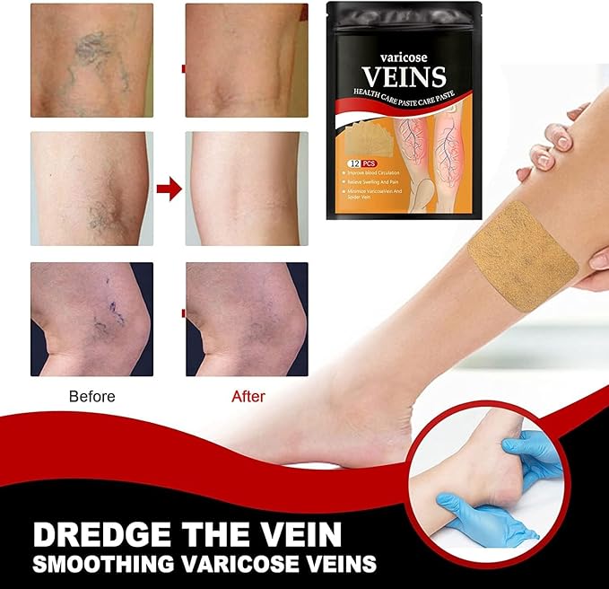 Varicose Veins Treatment Patch – 12 PCS